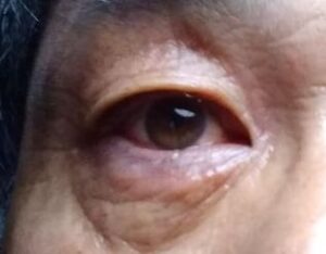 bloodshot 充血。瞼の腫れ。2022-07-22